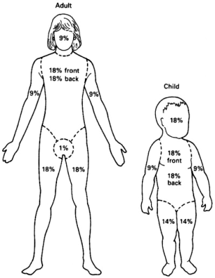 Rule Of Nines Pediatric Burn Chart